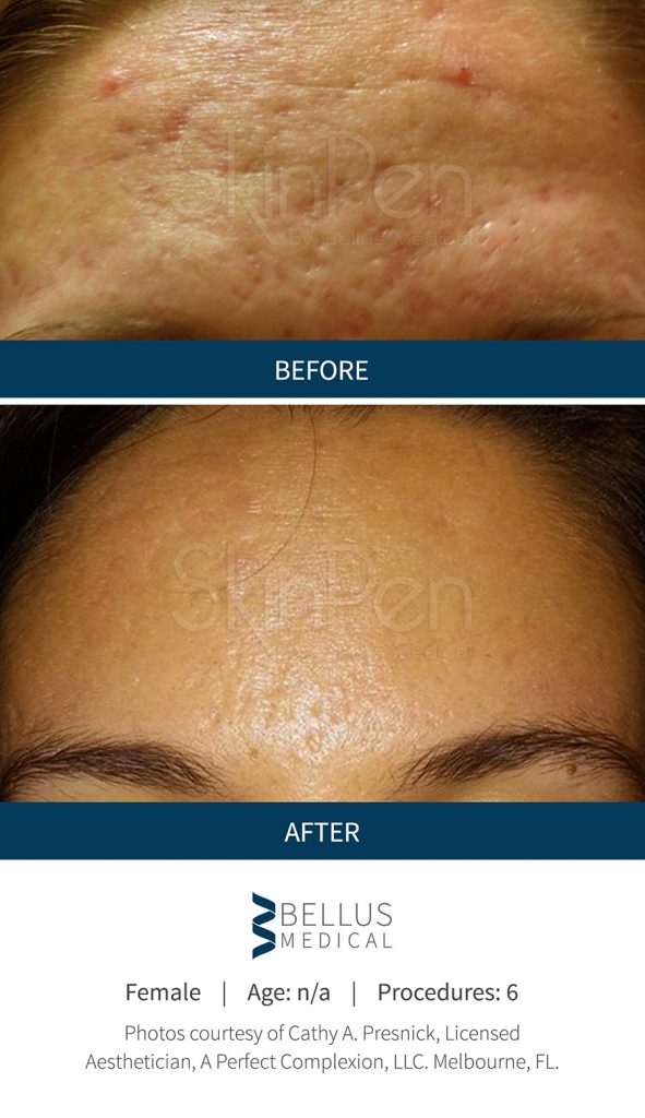 Microneedling