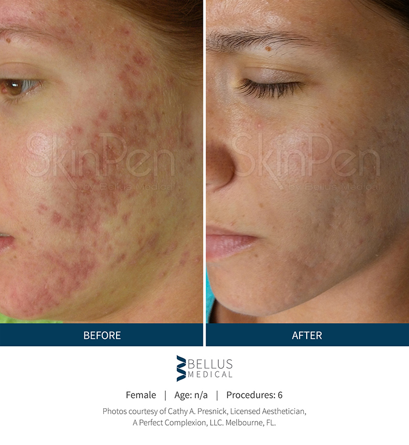 Microneedling Medical Aesthetics Of Muskoka